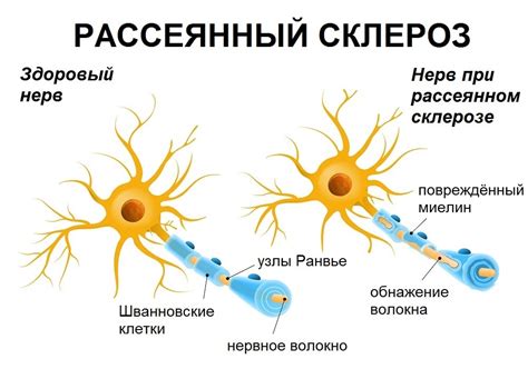 рассеянный склероз передается по наследству|Pассеянный склероз 